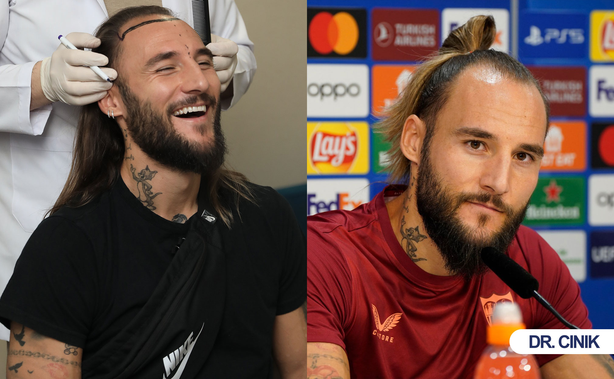 gudelj hair transplant