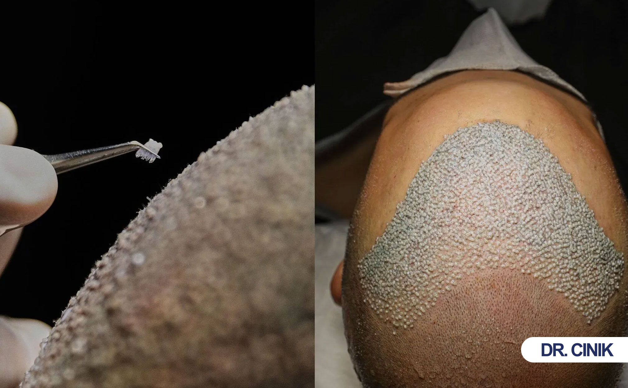 manuel-fue-hair-transplant