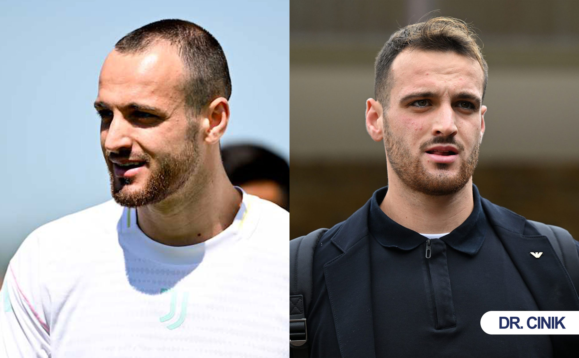 gatti hair transplant