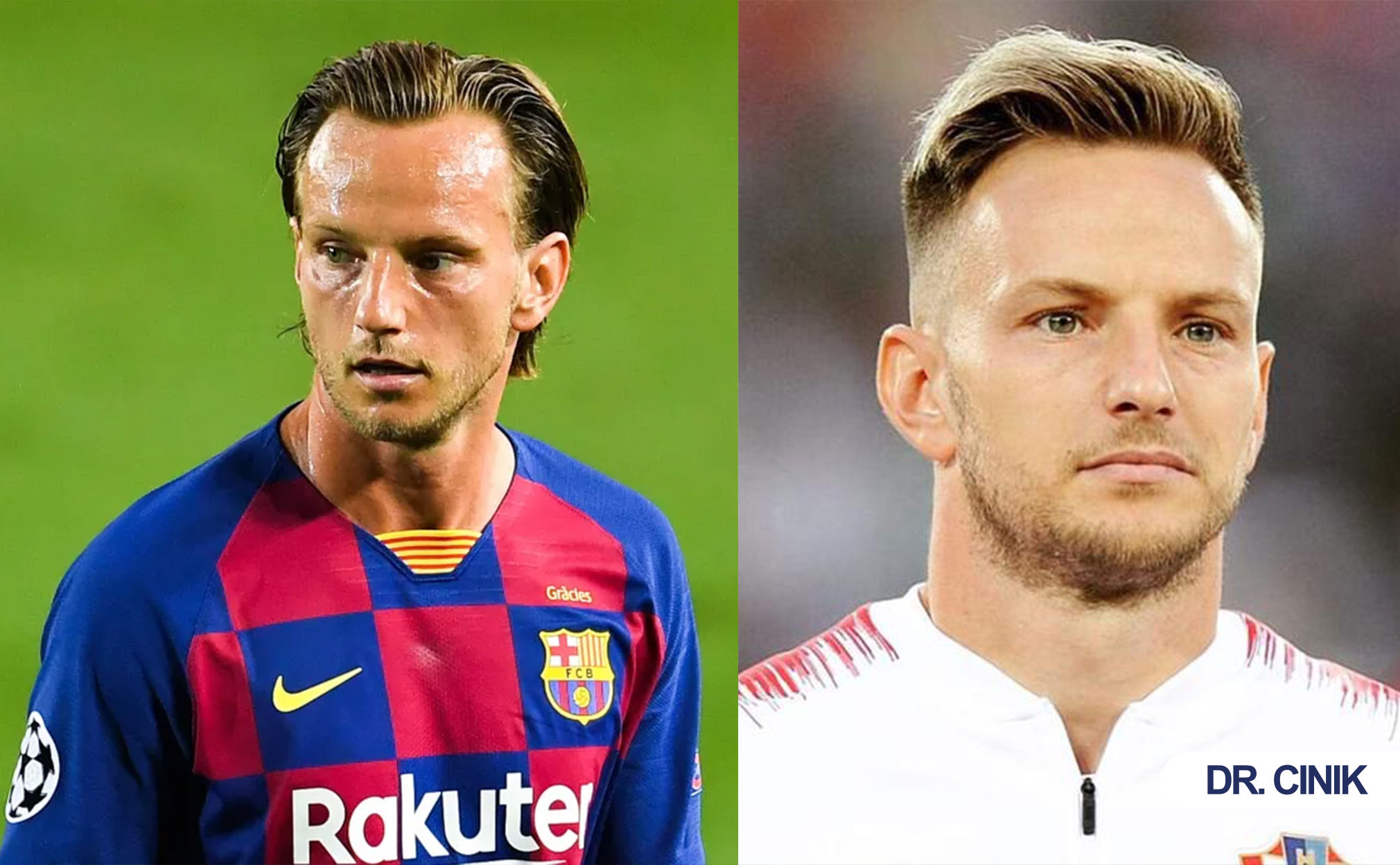 ivan rakitic hair transplant