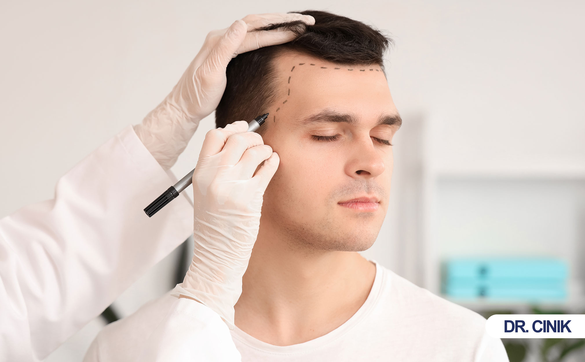 hair transplant