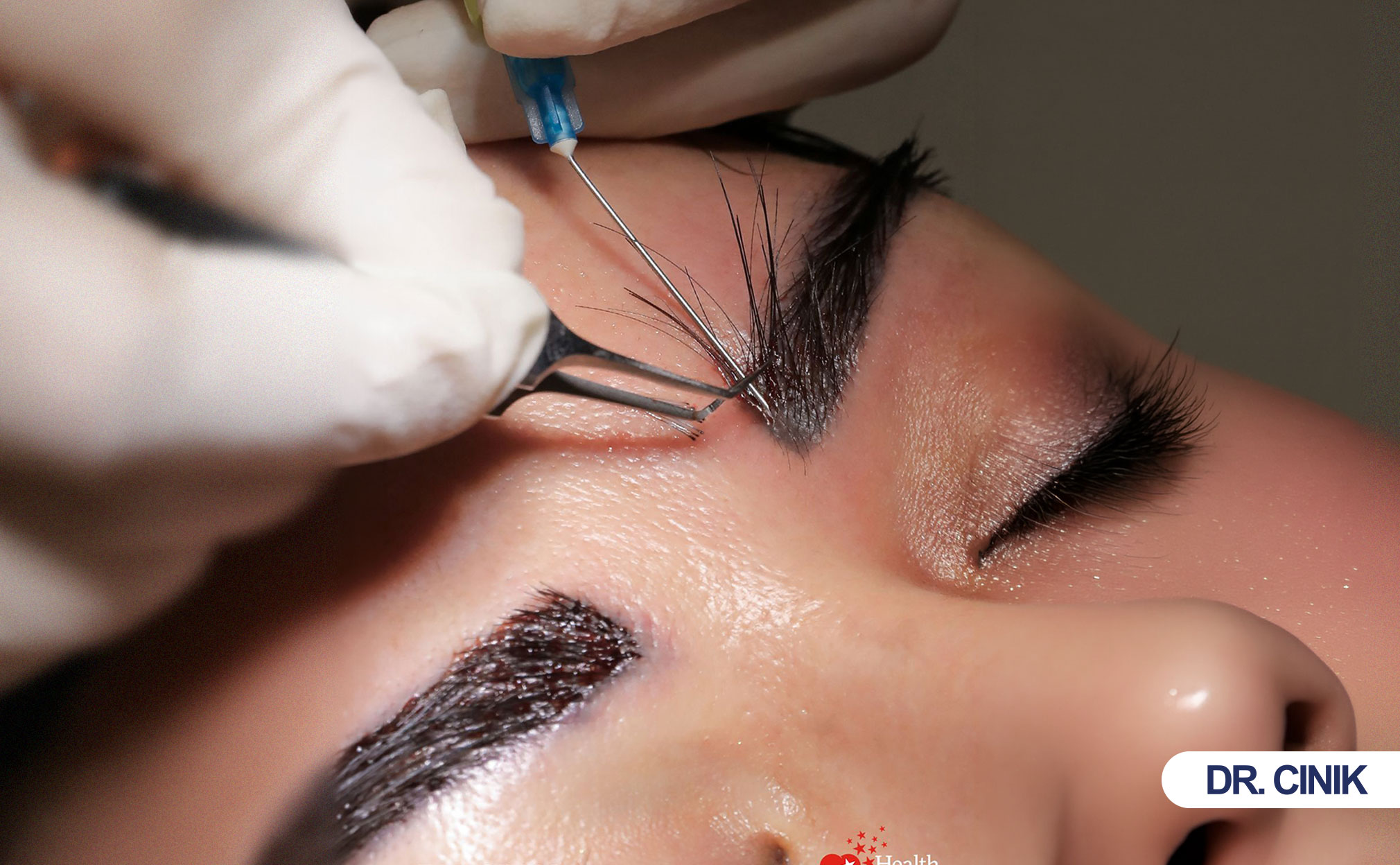 eyebrow hair transplant