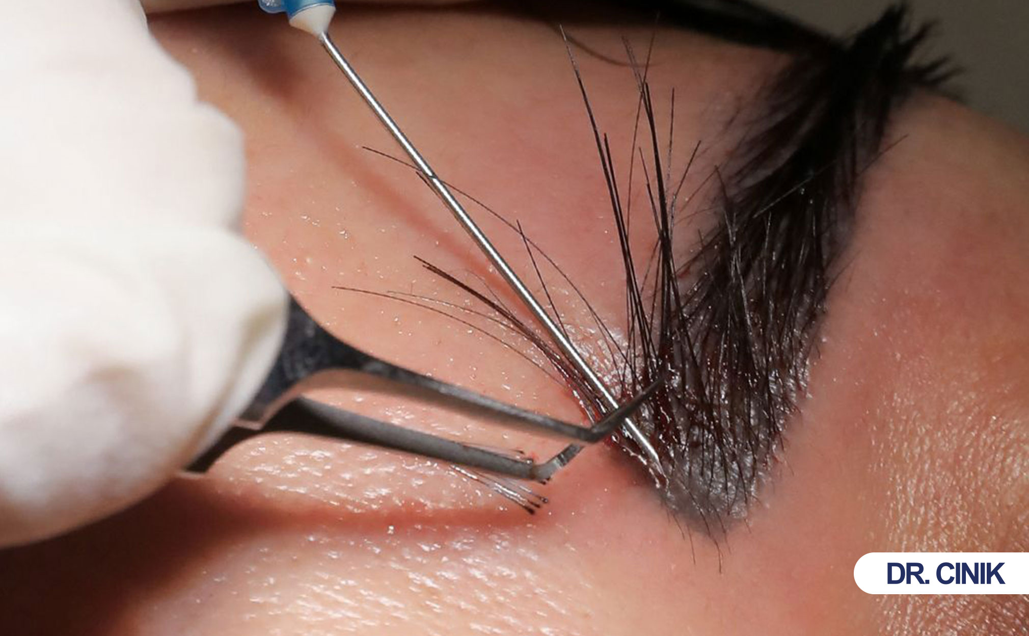 eyebrow hair transplant