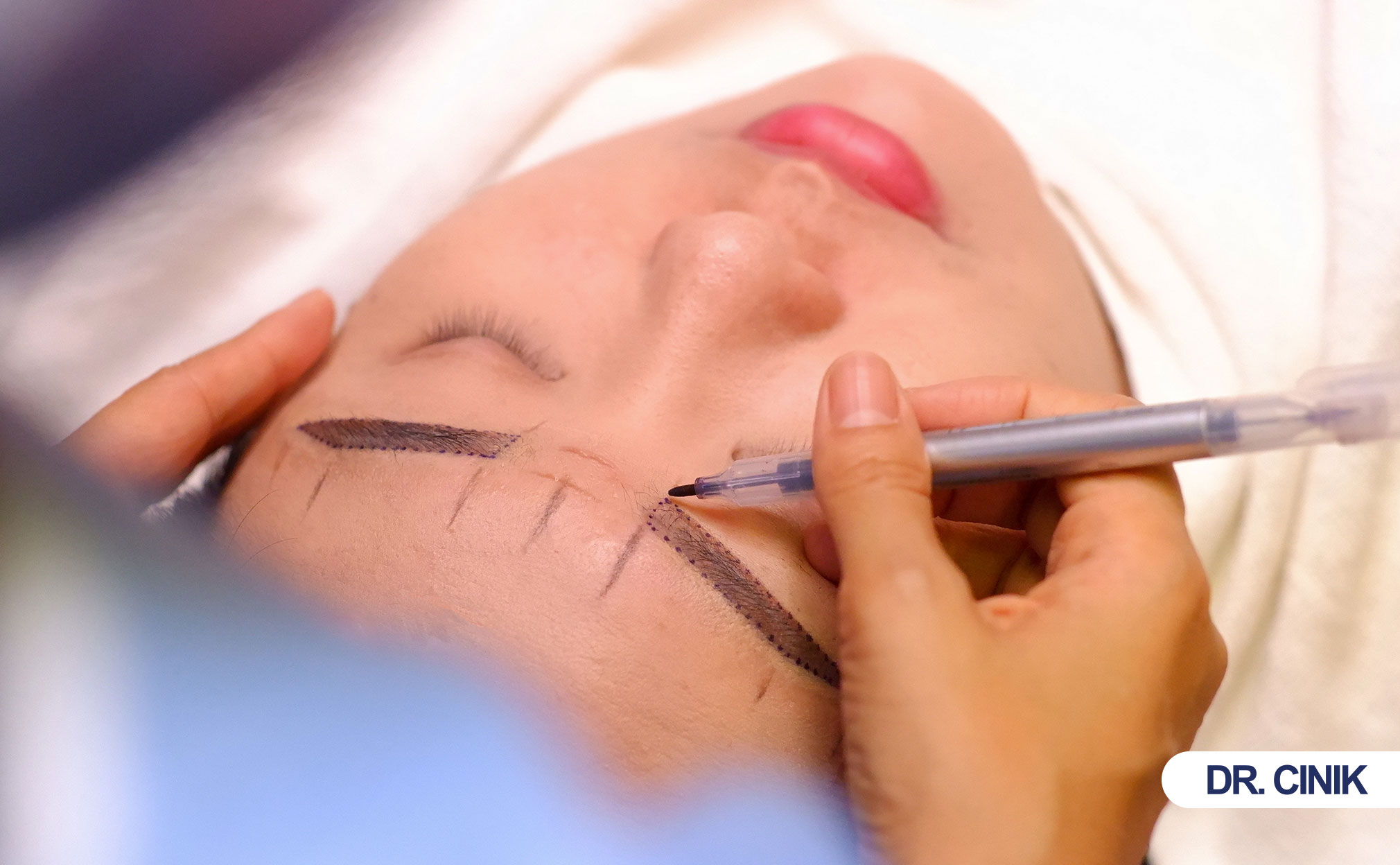 eyebrow hair transplant