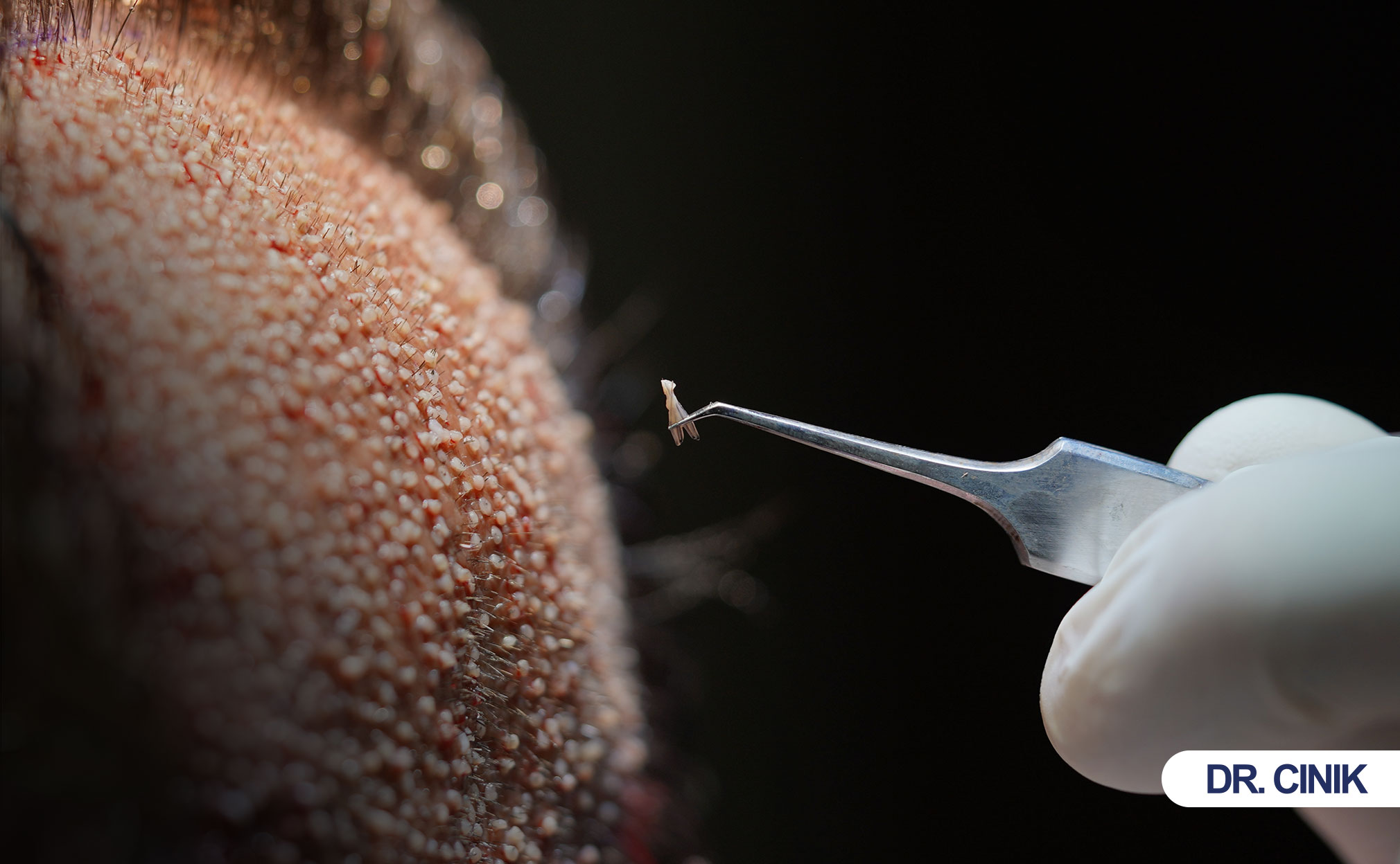 manuel-fue-hair-transplant