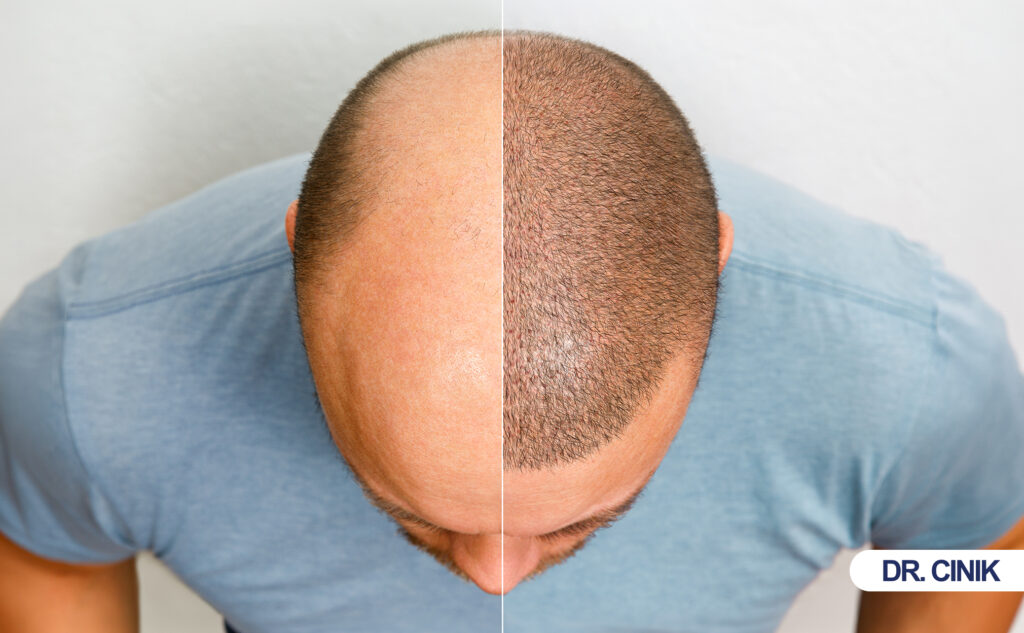 hair transplant