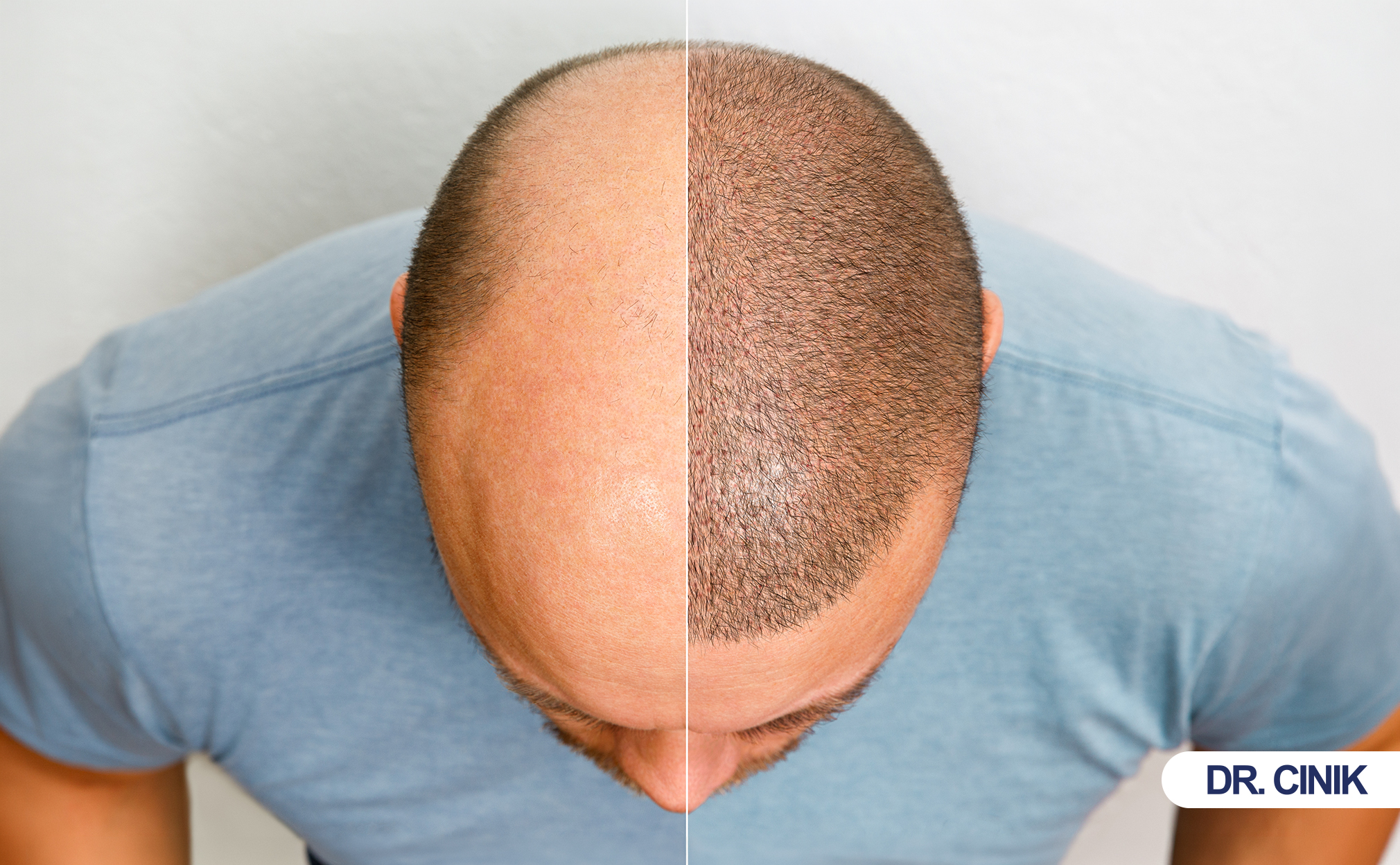 hair transplant