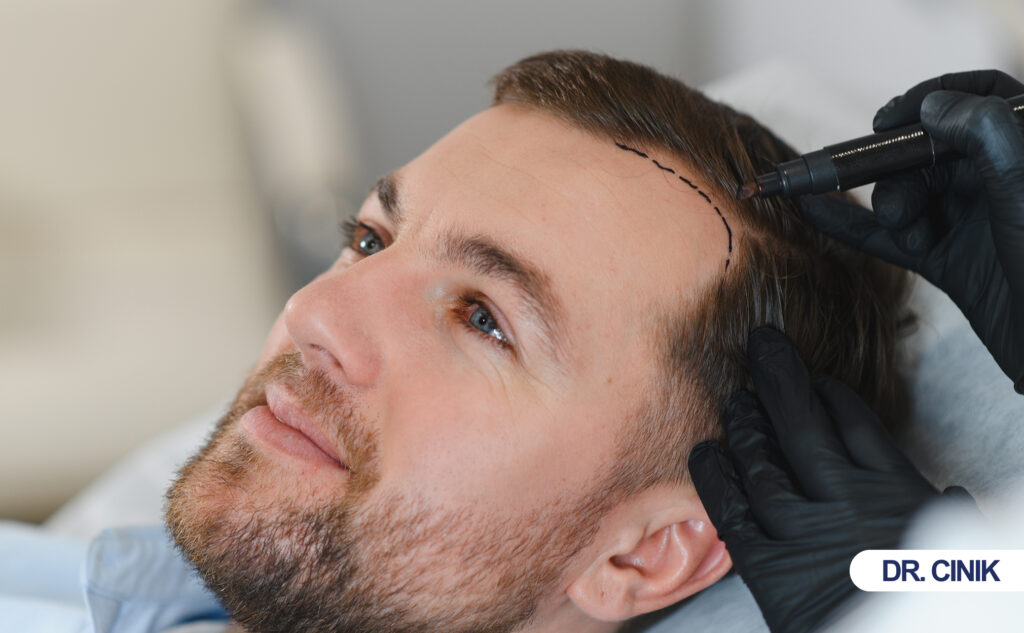 hair transplant