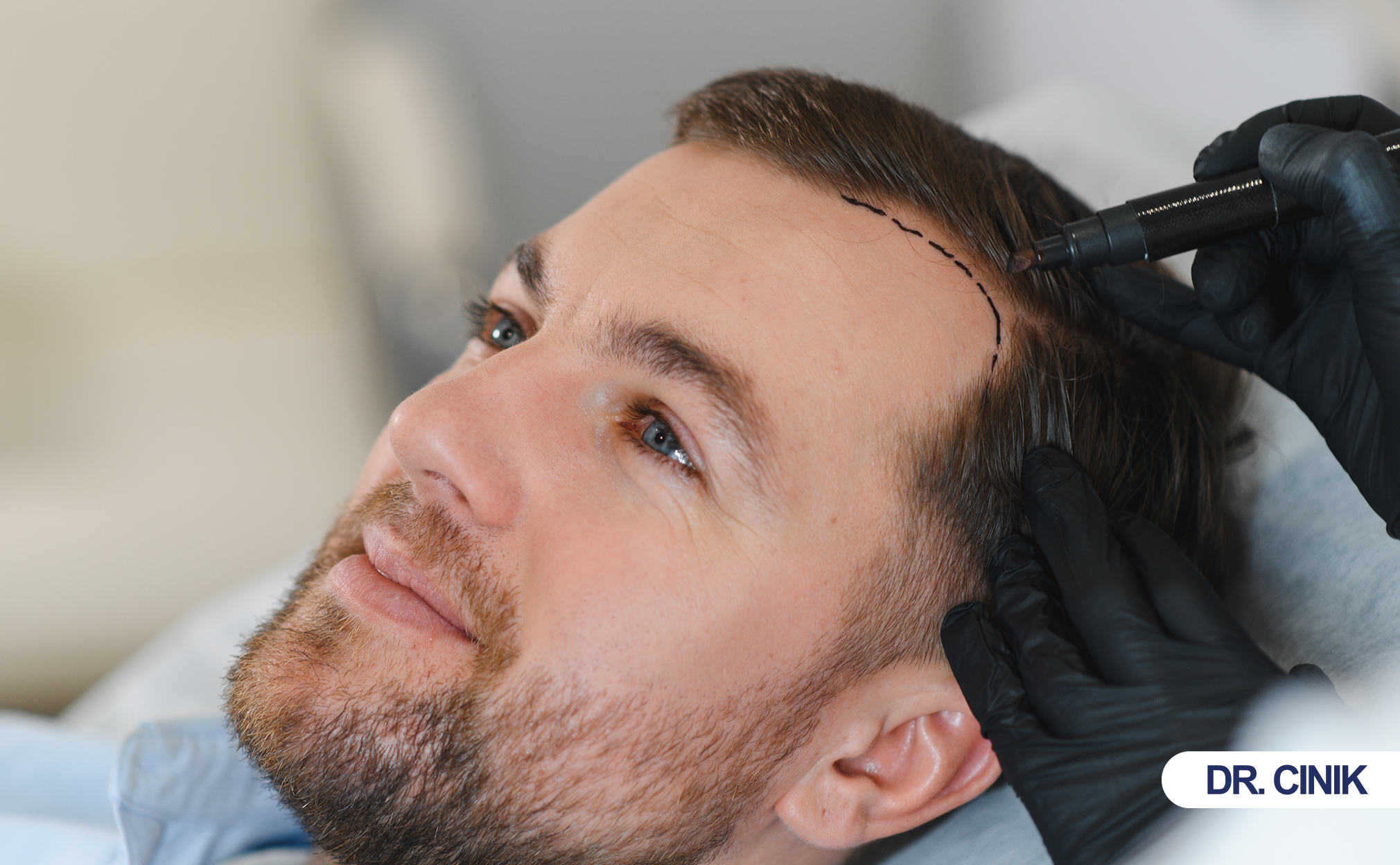hair transplant
