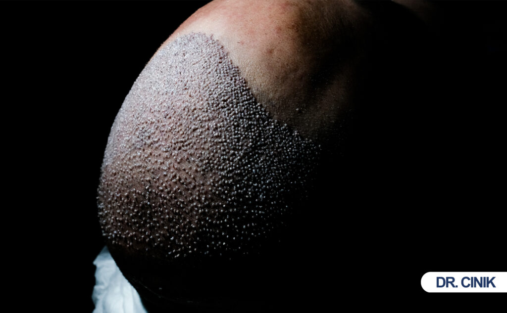 Folliculitis