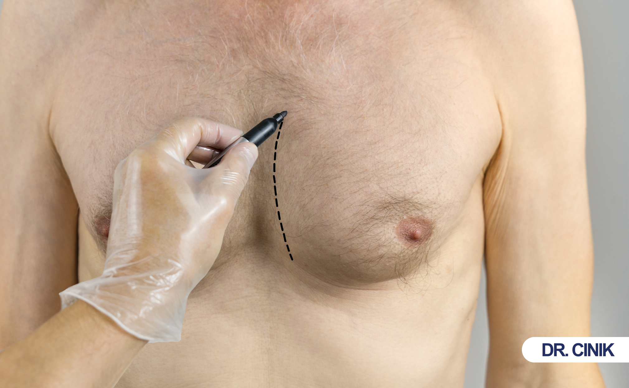 Gynecomastia