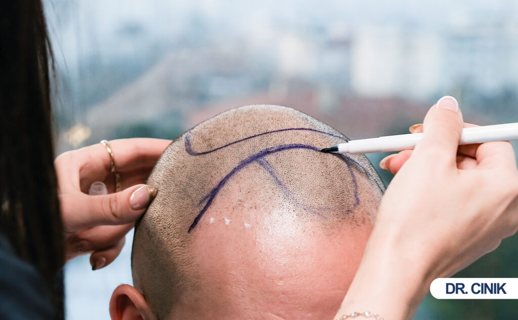 crown hair transplant