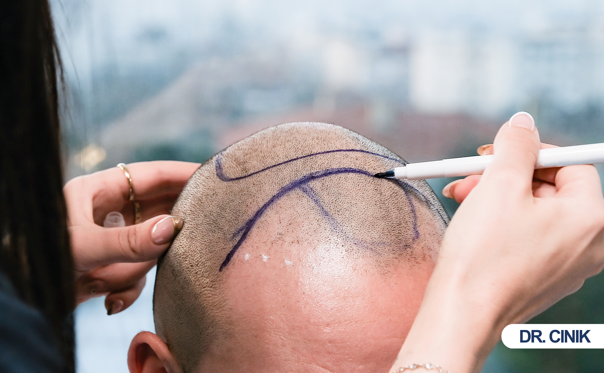 crown hair transplant