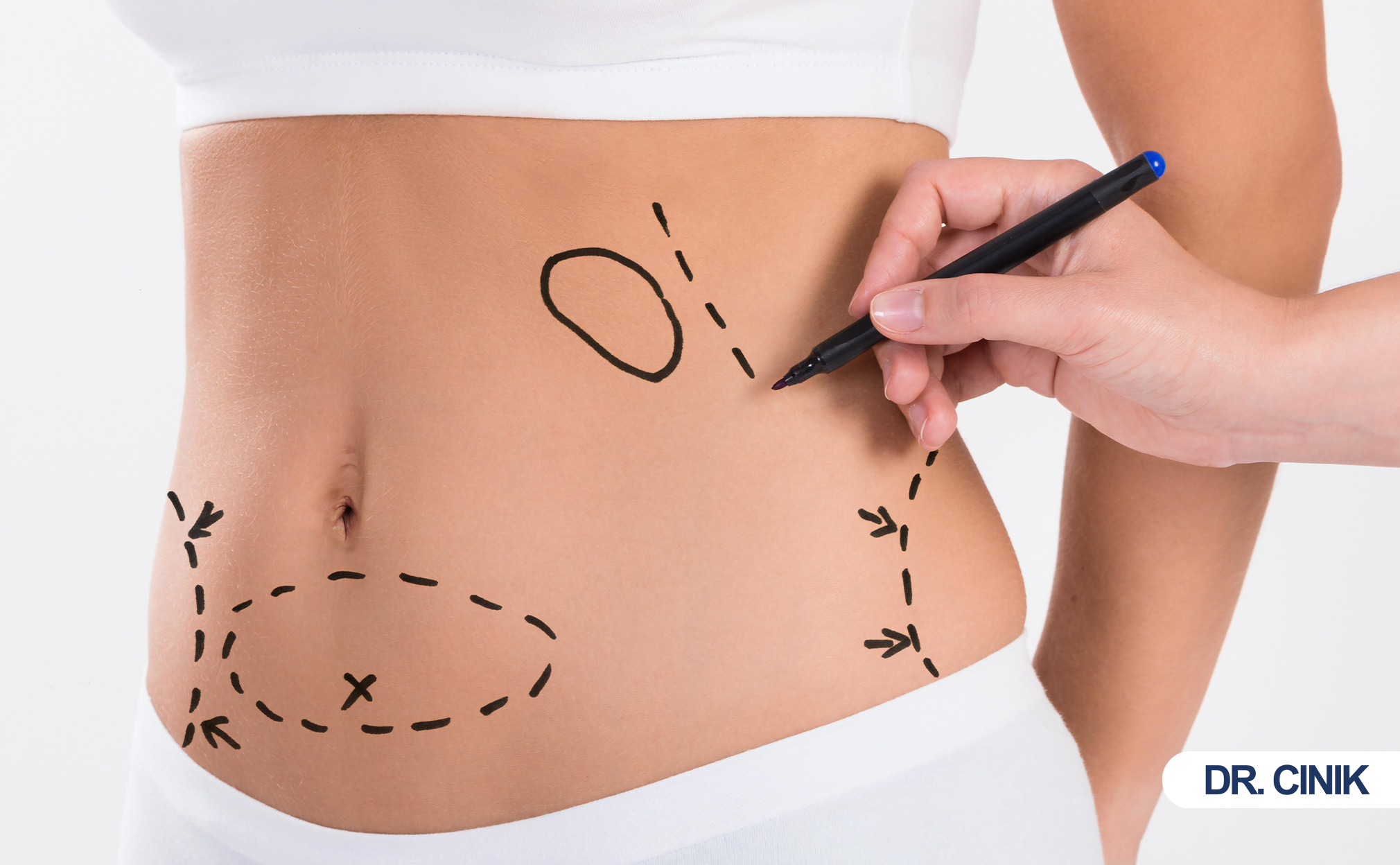 liposuction