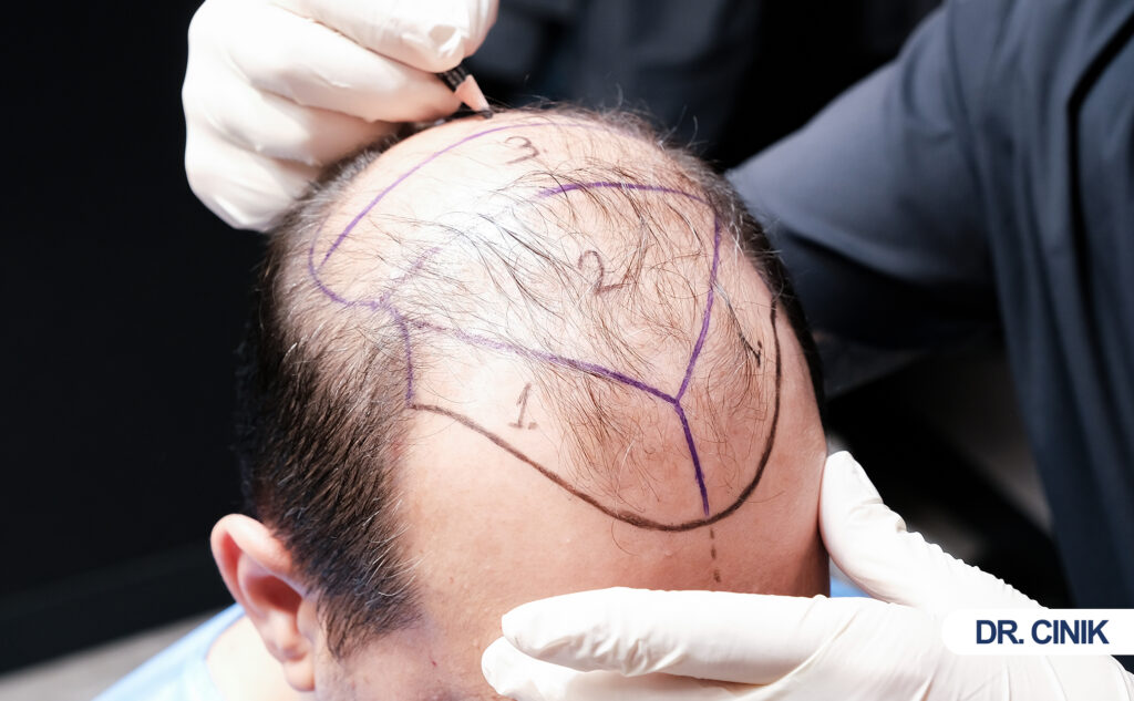 hair transplant